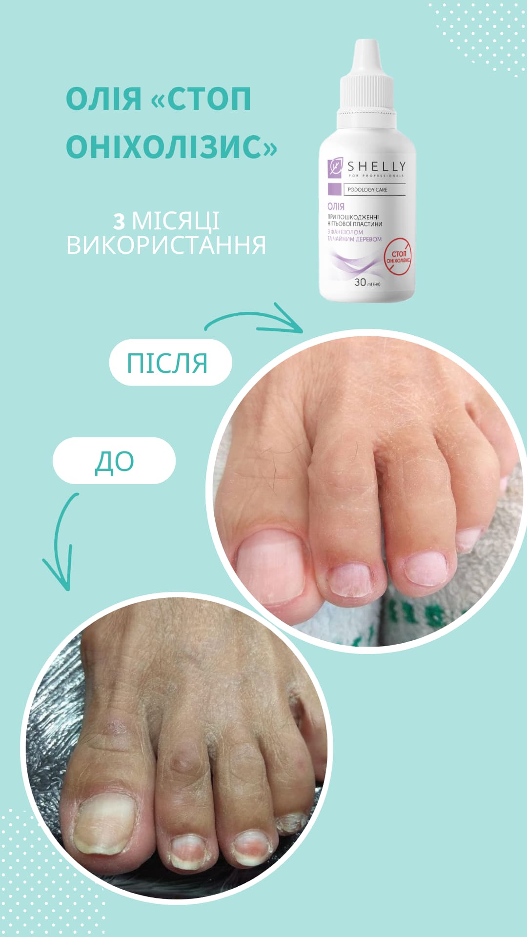 Оніхолізис: симптоми, причини та лікування